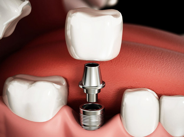 Dental Implants in south Hills 